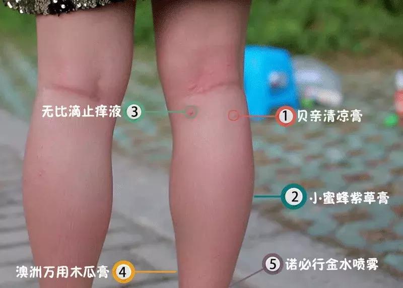 宝宝被蚊子叮了怎么止痒消肿？测评后我发现网红产品竟然最有用！