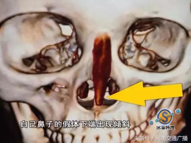 一女子因整容失败,一名女子整容失败