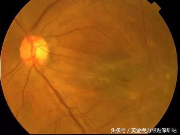 黄斑病变是眼癌吗,致眼盲疾病有哪些