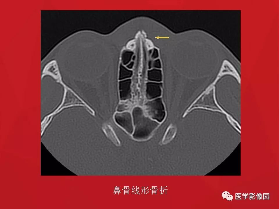 左侧鼻骨骨折伴鼻中隔骨折,双侧鼻骨及左上颌骨突骨折