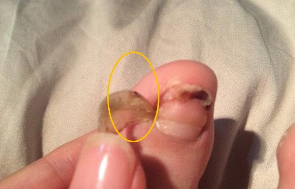 脚指甲长到肉里面怎么剪,脚指甲长到里面去了怎么剪