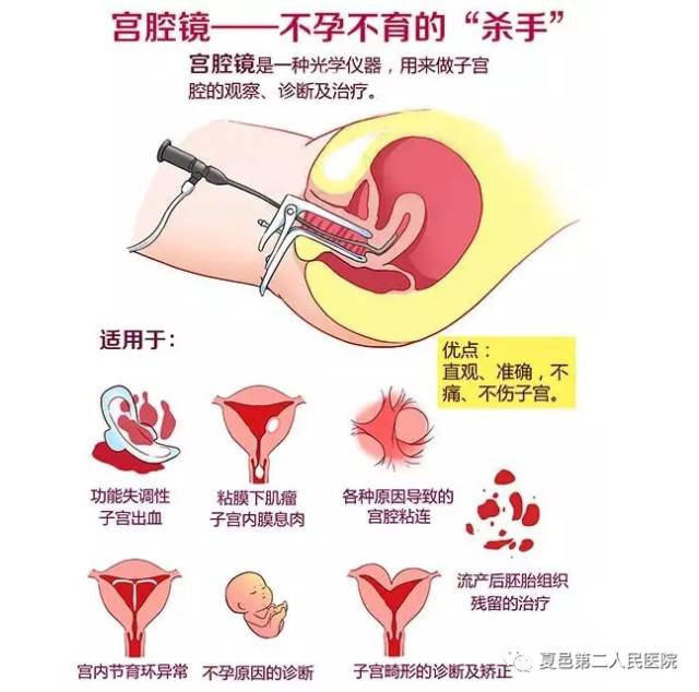 妇科宫腔镜探查术,宫腔镜内窥镜