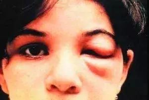 锥虫病对人类的危害,中国目前有锥蝽病吗