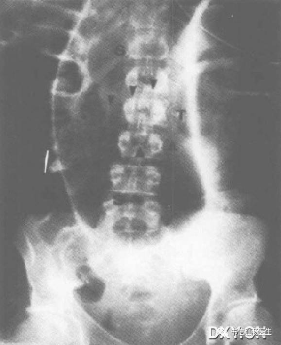 10种经典肠道影像征象：绳征、串珠征、螺纹征……你听过几个？