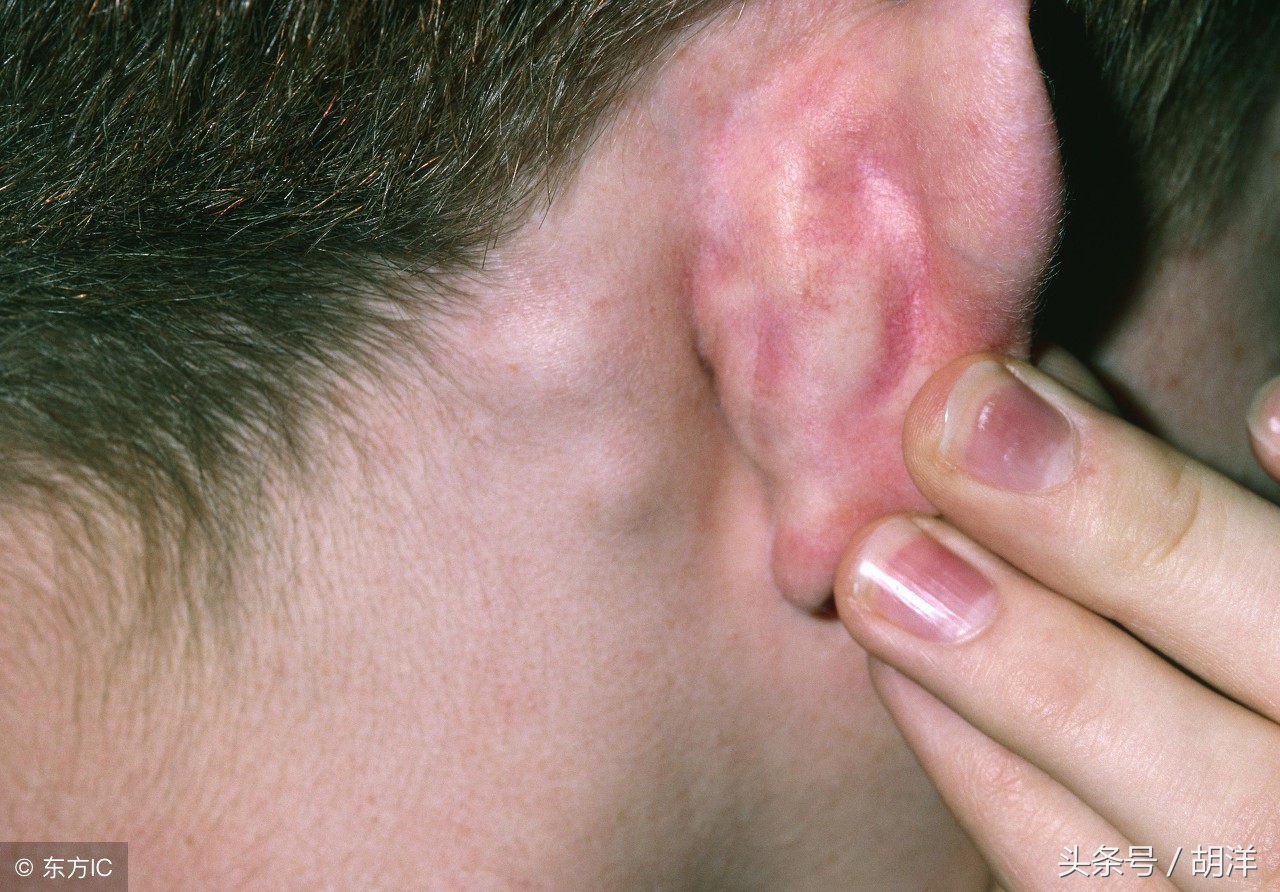 咽喉炎引起的淋巴结肿大多发性,咽喉炎引起淋巴结肿大会不会是hiv