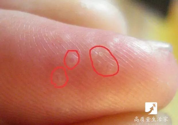 手上长水泡非常痒别抓这样处理,手上起小水泡看哪个科