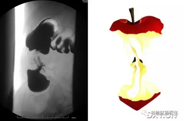 10种经典肠道影像征象详解