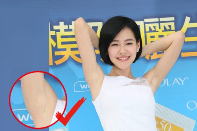 腋下不干净有干皮,腋下不干净会导致狐臭吗