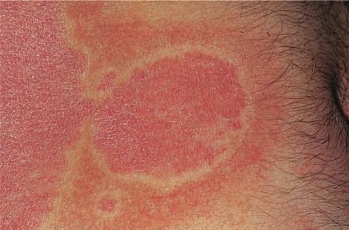 银屑病是什么样的病症,银屑病是免疫系统疾病