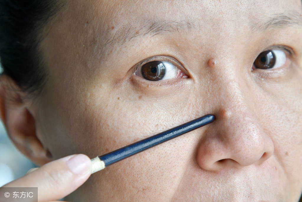 点痣膏点痣有什么危害,点痣需要注意什么才安全