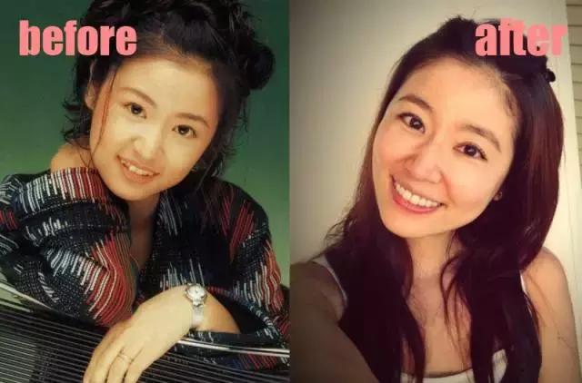 明星颜值变化杨幂,哪些明星整牙后变化巨大