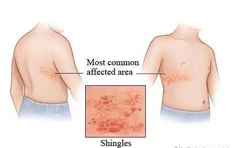 哺乳期妈妈得了带状疱疹,哺乳期带状疱疹会不会传染给孩子