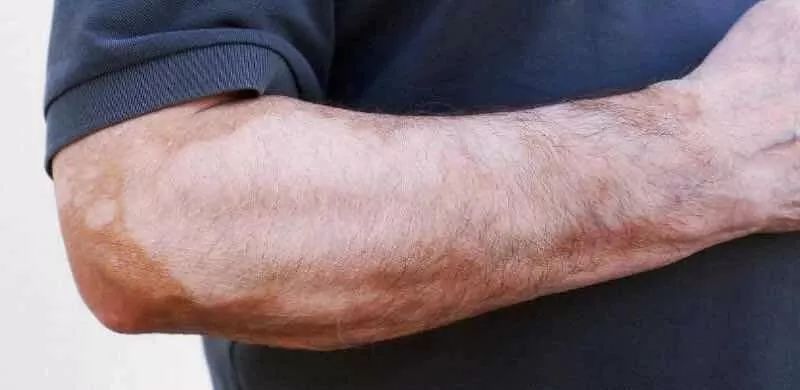 直播治疗白癜风最新特效药,白癜风治疗视频直播