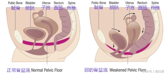 弱弱的盆底肌，并不是凯格尔能简单修复的，普拉提才是最好的方式