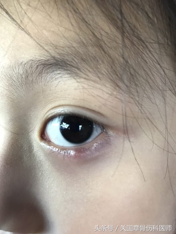 吃龙眼会导致上火眼睛红吗,吃龙眼会上火