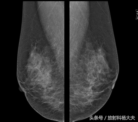 b超和钼靶检查肿瘤大小不一样,b超和钼靶肿块大小不一样