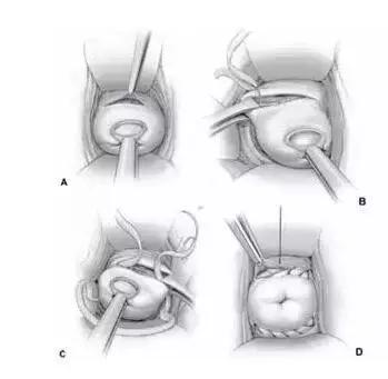孕期宫颈口松弛会突然流产么,宫颈松弛怀孕第一个月会流产吗