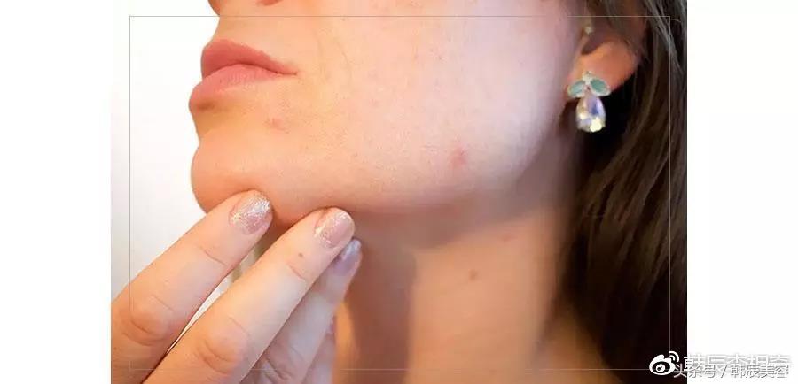 防止脸上长粉刺的方法,脸上长斑要当心