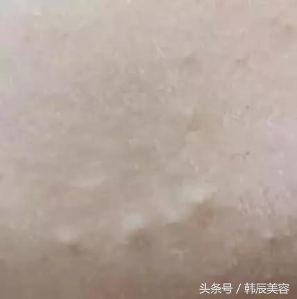 防止脸上长粉刺的方法,脸上长斑要当心