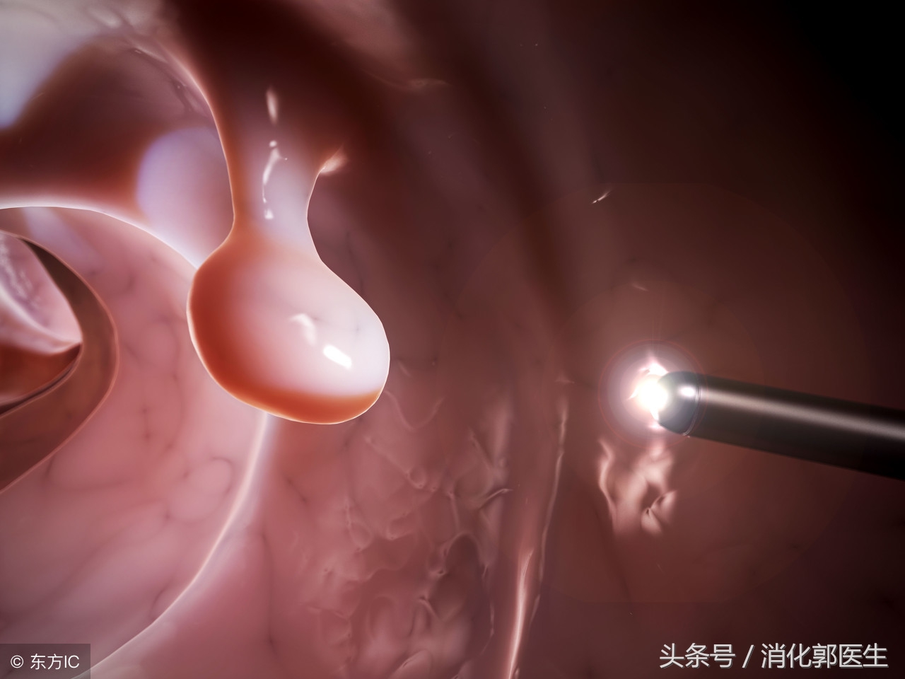 肠息肉不要紧吧,肠息肉不治疗后果会怎样