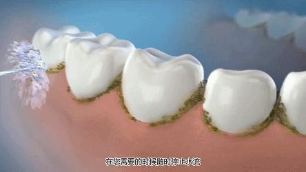 看牙太贵还不是因为你怕遭罪,不整牙有必要买冲牙器吗