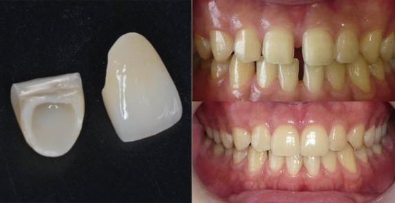 怎么缩小门牙牙缝,门牙牙缝怎么修复最简单方法