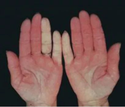 福州女子30多岁时牙齿掉光，竟是因为这种病……出现这种症状要注意！