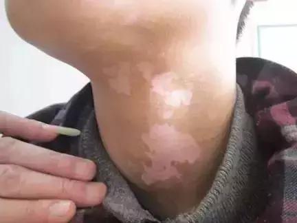 邯郸中药调理白癜风中医诊所,白癜风分型分期治疗的难度