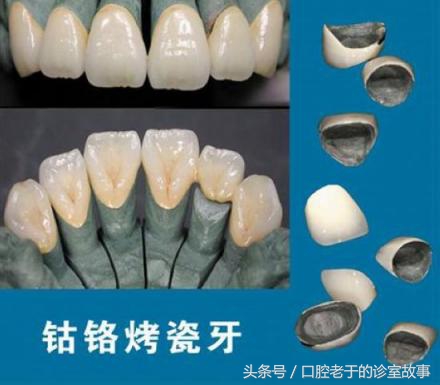 烤瓷冠与全瓷冠价格哪个贵,烤瓷冠多少钱一颗