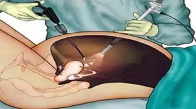 肾上腺肿瘤高血压,肾上腺肿瘤导致高血压怎么处理