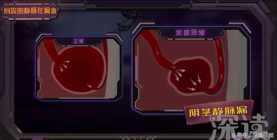 谁让你“兄弟”不给力,谁让你“痿”靡不振?阳痿诱发因素知多少