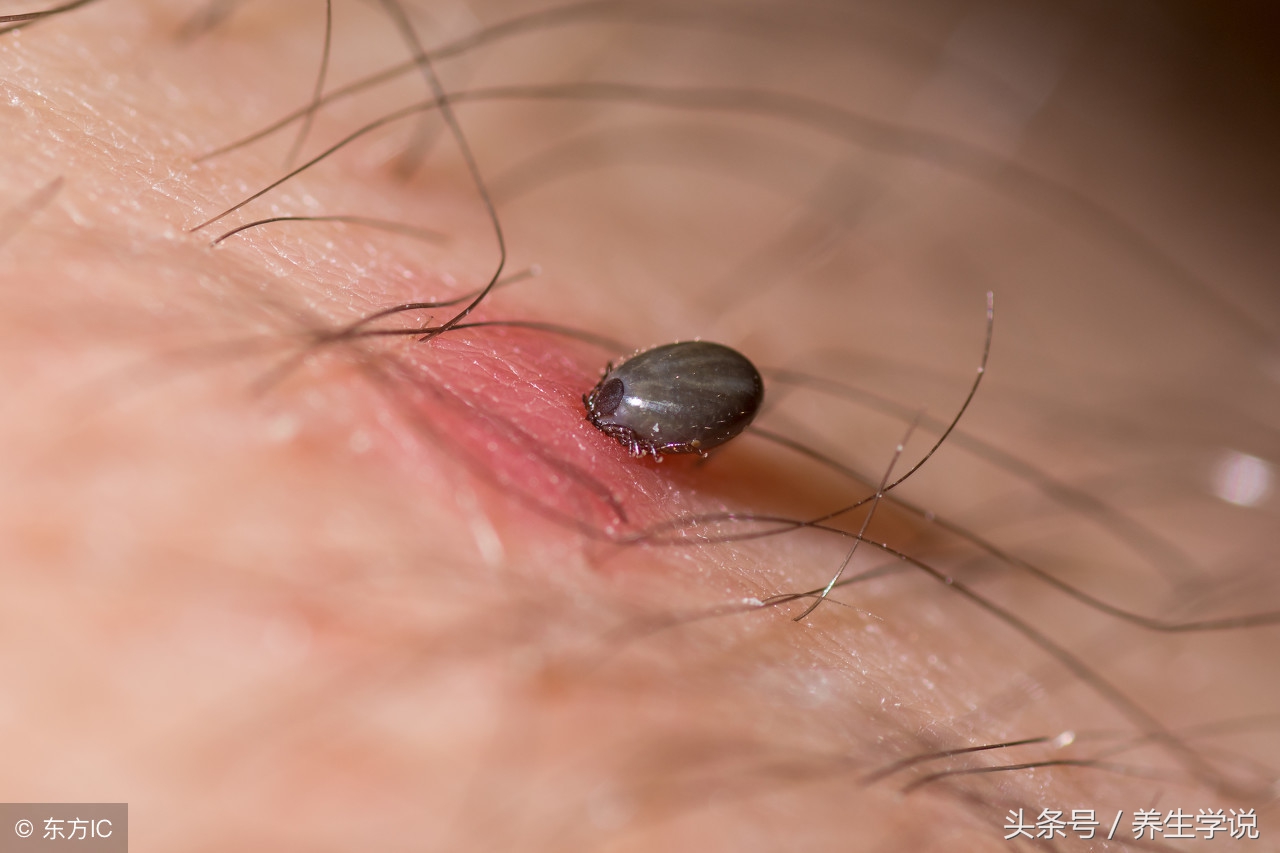脸上毛孔大是有螨虫吗,螨虫脸上的毛孔挤出白色条状物