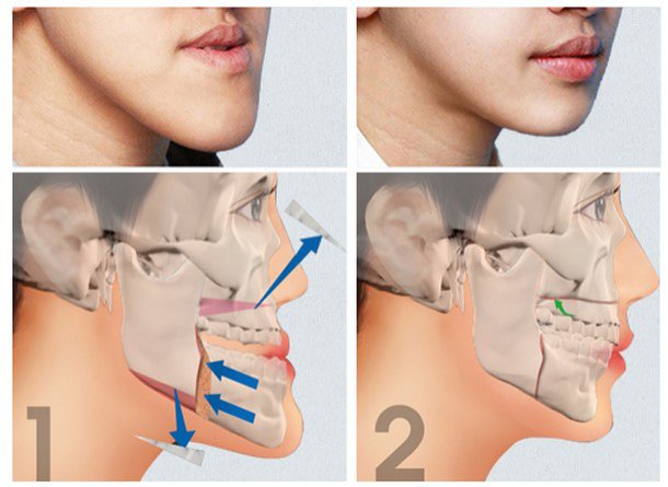 为什么有的人地包天那么不明显,为什么有一颗牙齿是地包天