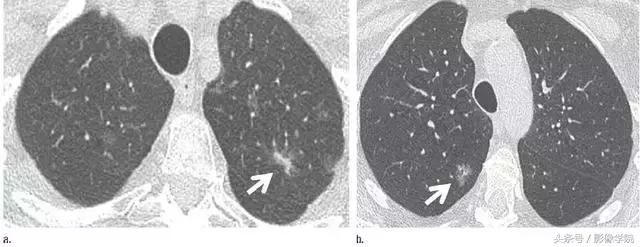 肺结节14种影像,一百例有结果的肺结节影像分析