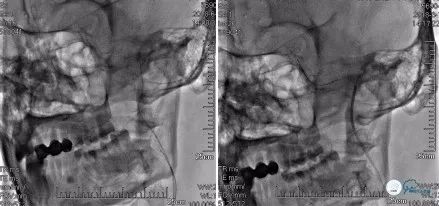 颈动脉闭塞介入治疗的风险,慢性动脉闭塞症病例