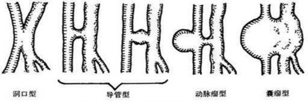 穿刺股动脉并发症,穿刺部位并发症预防及处理