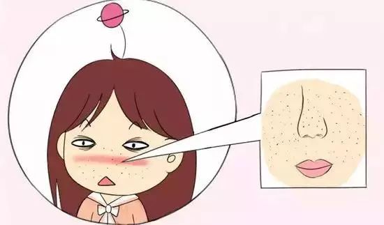 用了泥膜黑头祛不掉,黑头去不去除