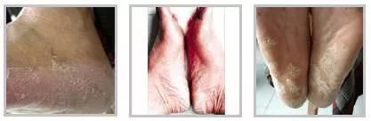 怎么才可以拯救汗脚,如何拯救脚臭