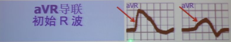 「CHC2018」郭继鸿：心电学进展2018