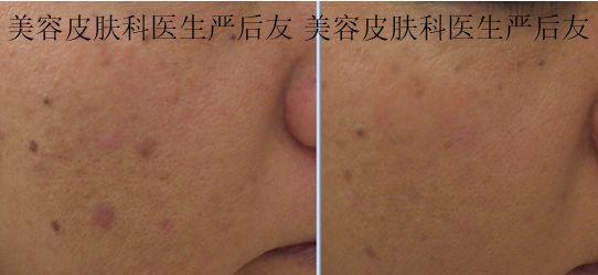 毛孔粗大如何治疗最好最快,如何治疗黑头和毛孔粗大