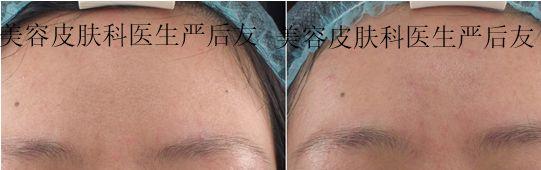 治疗毛孔粗大,激光治疗毛孔粗大多少钱