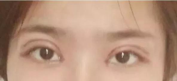 双眼皮刚割完不对称后来好了,全切双眼皮拆线后不对称