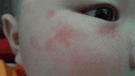 新生儿常见七种皮肤病,新生儿皮肤病中医辨证