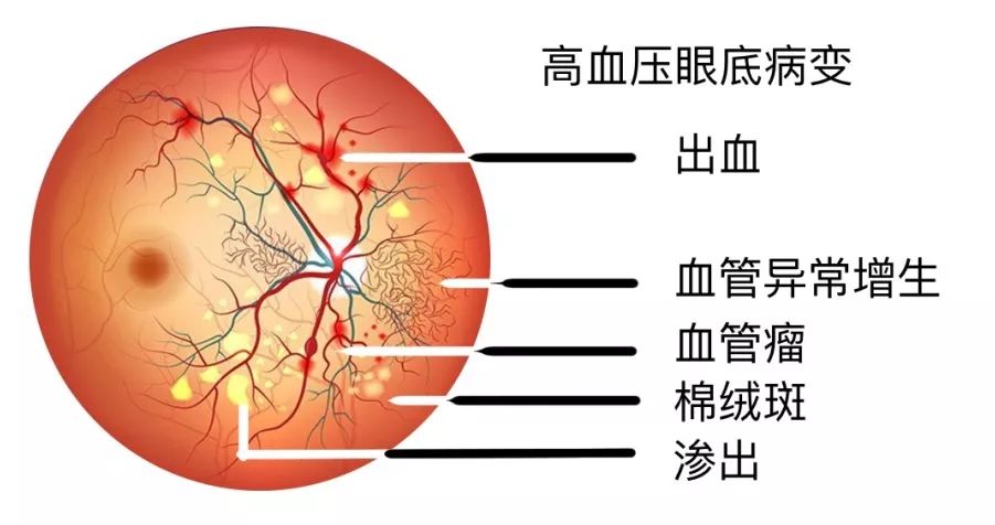 高血压怎么样才能发生猝死,高血压隐形杀手