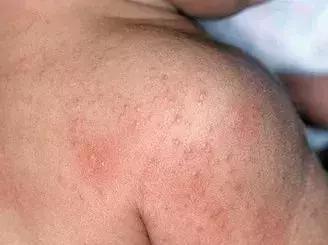 宝宝长小疹子后溃烂,宝宝的红疹子溃烂了