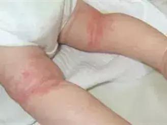 宝宝身上一大片的包是怎么回事,宝宝身上好多片包