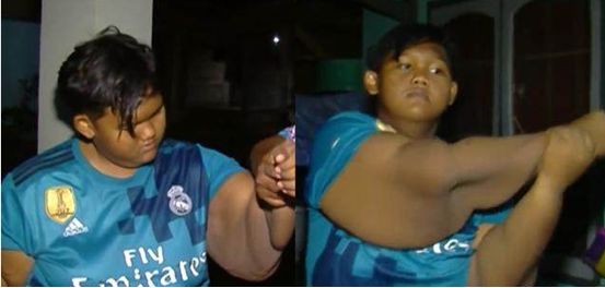 印尼最胖男孩减肥成功目前情况,世界最胖的印尼男孩成功减肥