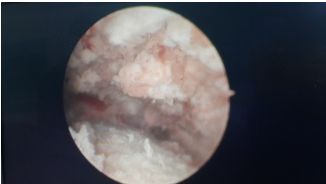 调理子宫内膜的中医疗法,女性内膜修补术过程