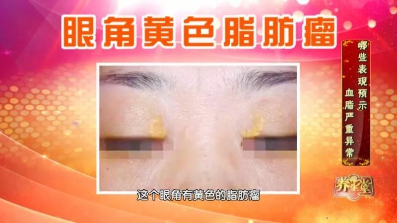 眼角血脂斑怎么消除,眼角长什么说明血脂高