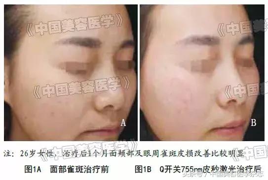 q开关激光祛斑效果,q开关激光祛斑怎么样